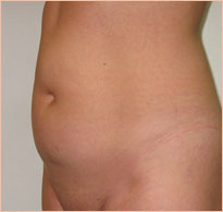 Фото до миниабдоминопластики
