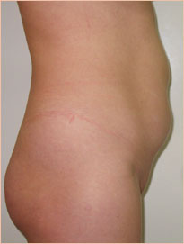 Фото до миниабдоминопластики