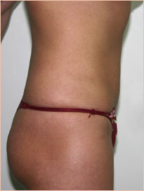 Фото после миниабдоминопластики