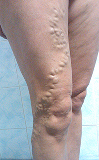 Фото до лечения вен