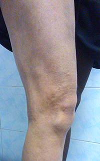 Фото после лечения вен