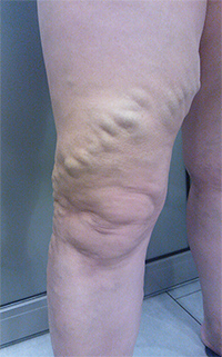 Фото до лечения вен