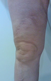 Фото после лечения вен