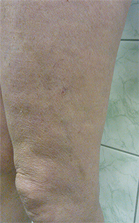 Фото после лечения вен