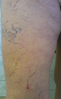 Фото до лечения вен