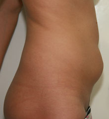 Фото до липосакции