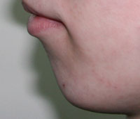 Фото до коррекции формы подбородка