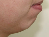 Фото до коррекции формы подбородка