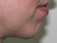 Фото после коррекции формы подбородка