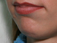 Фото до коррекции формы подбородка