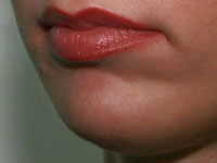 Фото после коррекции формы подбородка