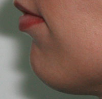 Фото до коррекции формы подбородка