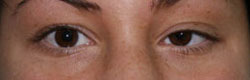 Фото до коррекции птоза (опущения) верхнего века