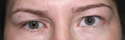 Фото до коррекции птоза (опущения) верхнего века