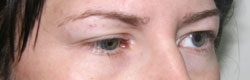 Фото до коррекции птоза (опущения) верхнего века