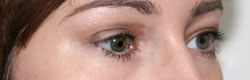 Фото после коррекции птоза (опущения) верхнего века