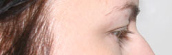 Фото до коррекции птоза (опущения) верхнего века