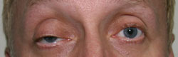 Фото до коррекции птоза (опущения) верхнего века