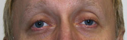 Фото после коррекции птоза (опущения) верхнего века
