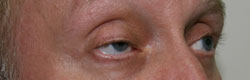 Фото до коррекции птоза (опущения) верхнего века