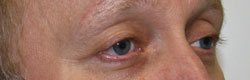 Фото после коррекции птоза (опущения) верхнего века