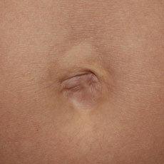 Фото до устранения пупочной грыжи