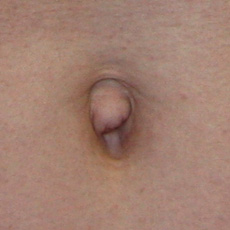 Фото до устранения пупочной грыжи