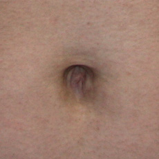 Фото после устранения пупочной грыжи