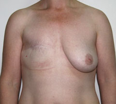 Фото до реконструкции груди