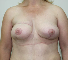 Фото после реконструкции груди