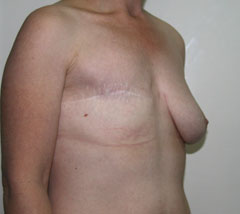 Фото до реконструкции груди