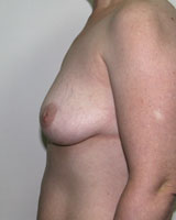 Фото до реконструкции груди