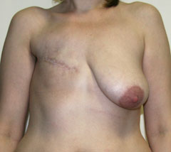 Фото до реконструкции груди