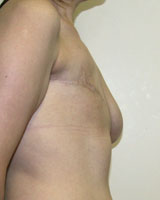 Фото до реконструкции груди