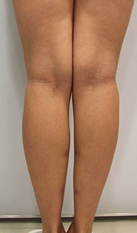 Фото после удаления геля