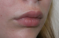 Фото до удаления геля