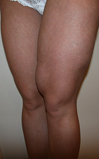 Фото до удаления геля