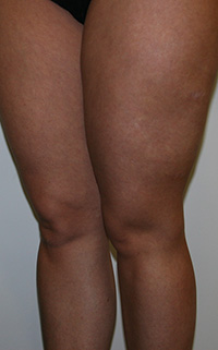 Фото после удаления геля