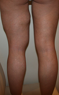 Фото до удаления геля