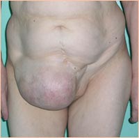 Фото до устранения послеоперационной грыжи