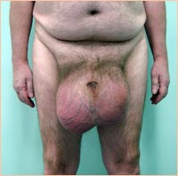 Фото до устранения паховой грыжи