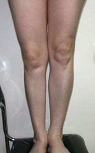 Фото до коррекции асимметрии голеней