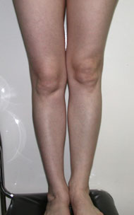 Фото после коррекции асимметрии голеней