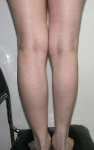 Фото до коррекции асимметрии голеней