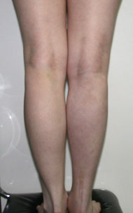 Фото после коррекции асимметрии голеней