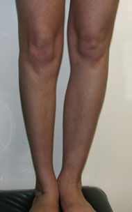 Фото до коррекции асимметрии голеней