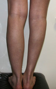 Фото до коррекции асимметрии голеней