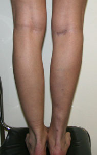 Фото после коррекции асимметрии голеней