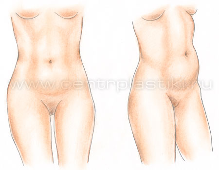 Эндоскопическая абдоминопластика