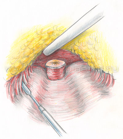 Эндоскопическая абдоминопластика